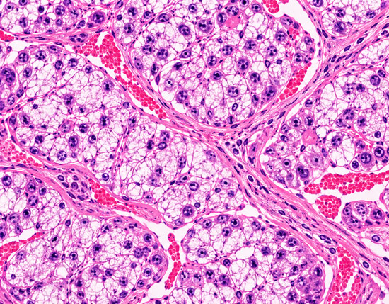 Cancer cell